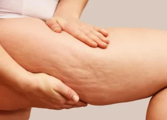 woman-showing-her-legs-with-cellulite-1-1024x549-1