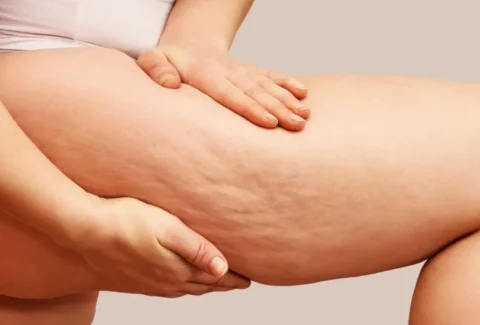 woman-showing-her-legs-with-cellulite-1-1024x549-1