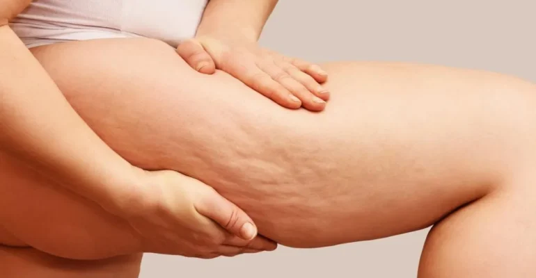 woman-showing-her-legs-with-cellulite-1-1024x549-1