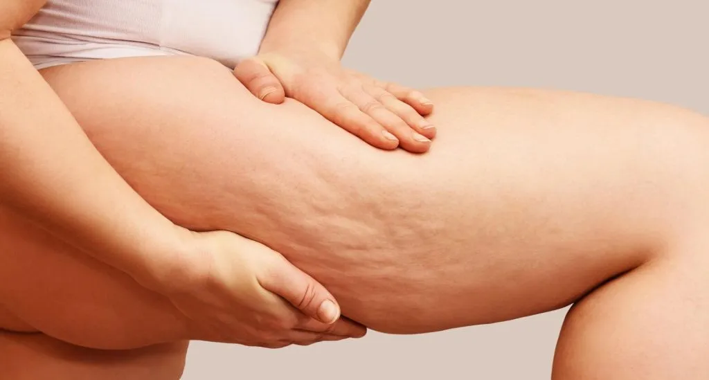 woman-showing-her-legs-with-cellulite-1-1024x549-1